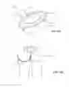 Fig. 27 - Reduced pressure therapy of the sacral region
