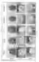 Fig. 05 - MANAGEMENT OF OSTEOARTHRITIS USING POOLED ALLOGENEIC MESENCHYMAL STEM CELLS
