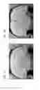 Fig. 02 - Functionalized magnetic nanoparticles and use in imaging amyloid deposits and neurofibrillary tangles