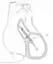 Fig. 01 - CATHETER PUMP ASSEMBLY INCLUDING A STATOR