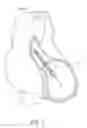 Fig. 05 - CATHETER PUMP ASSEMBLY INCLUDING A STATOR