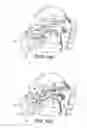 Fig. 05 - Delivery Device and Method