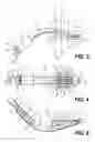 Fig. 03 - Artificial airway