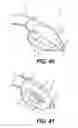 Fig. 15 - Artificial airway