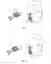 Fig. 03 - A PLASTER DEVICE