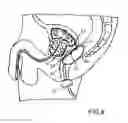 Fig. 06 - Rectal balloon with locking stopper