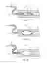 Fig. 03 - Balloon catheter with elastomeric sheath and methods