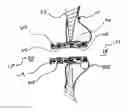 Fig. 01 - METHODS AND DEVICES FOR INTRA-ATRIAL SHUNTS HAVING SELECTABLE FLOW RATES