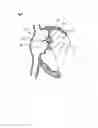 Fig. 03 - METHODS AND DEVICES FOR INTRA-ATRIAL SHUNTS HAVING SELECTABLE FLOW RATES