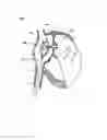 Fig. 04 - METHODS AND DEVICES FOR INTRA-ATRIAL SHUNTS HAVING SELECTABLE FLOW RATES