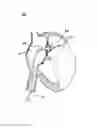 Fig. 06 - METHODS AND DEVICES FOR INTRA-ATRIAL SHUNTS HAVING SELECTABLE FLOW RATES