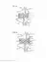 Fig. 09 - METHODS AND DEVICES FOR INTRA-ATRIAL SHUNTS HAVING SELECTABLE FLOW RATES