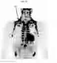 Fig. 11 - Methods and devices for activating brown adipose tissue using electrical energy