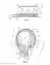Fig. 04 - SELF EXPANDING ELECTRODE CUFF