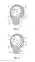 Fig. 07 - SELF EXPANDING ELECTRODE CUFF