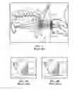 Fig. 02 - Method of stimulating a hypoglossal nerve for controlling the position of a patient's tongue