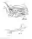 Fig. 03 - Method of stimulating a hypoglossal nerve for controlling the position of a patient's tongue