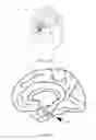 Fig. 02 - MINIMALLY INVASIVE IMPLANTABLE BRAIN STIMULATION DEVICES AND METHODS FOR IMPLANTING SAME