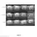 Fig. 06 - REGENERATION OF NERVE FIBERS