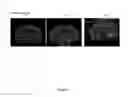 Fig. 08 - REGENERATION OF NERVE FIBERS