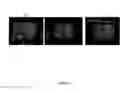 Fig. 10 - REGENERATION OF NERVE FIBERS