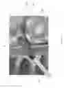 Fig. 07 - Combined local delivery of therapeutic agents using interventional devices and radiation