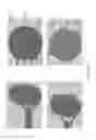 Fig. 26 - Combined local delivery of therapeutic agents using interventional devices and radiation