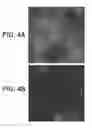 Fig. 05 - SYSTEMS AND METHODS FOR TREATING ABSCESSES AND INFECTED FLUID COLLECTIONS