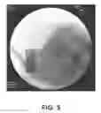 Fig. 06 - SYSTEMS AND METHODS FOR TREATING ABSCESSES AND INFECTED FLUID COLLECTIONS