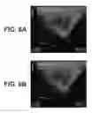 Fig. 07 - SYSTEMS AND METHODS FOR TREATING ABSCESSES AND INFECTED FLUID COLLECTIONS