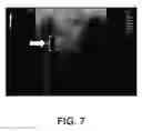 Fig. 08 - SYSTEMS AND METHODS FOR TREATING ABSCESSES AND INFECTED FLUID COLLECTIONS