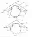 Fig. 03 - Ice cap for electric cable