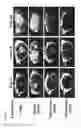 Fig. 11 - C-myc antisense oligonucleotides and methods for using the same to treat cell-proliferative disorders