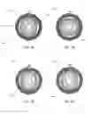 Fig. 03 - Method for manufacturing bulk metallic glass-based strain wave gear components