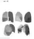 Fig. 33 - Method for extracting airways and pulmonary lobes and apparatus therefor
