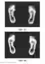 Fig. 11 - Method and apparatus for detecting and monitoring a foot pre-ulcer