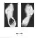 Fig. 14 - Method and apparatus for detecting and monitoring a foot pre-ulcer