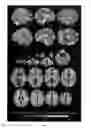 Fig. 07 - Adaptive pattern recognition for psychosis risk modelling