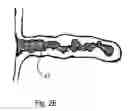 Fig. 08 - DEVICES, SYSTEMS, AND HYBRID METHODS FOR ATRIAL APPENDAGE OCCLUSION USING LIGHT CURE