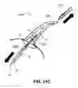 Fig. 41 - DEVICES, SYSTEMS, AND HYBRID METHODS FOR ATRIAL APPENDAGE OCCLUSION USING LIGHT CURE