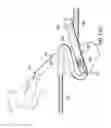 Fig. 31 - Articulating suturing device and method