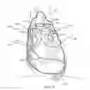 Fig. 03 - Methods of treating a cardiac arrhythmia by thoracoscopic production of a cox maze III lesion set