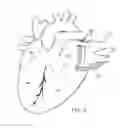 Fig. 04 - Methods of treating a cardiac arrhythmia by thoracoscopic production of a cox maze III lesion set