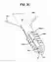 Fig. 08 - Suture anchor with pulley
