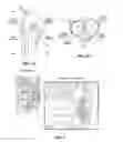Fig. 04 - Suture passer with radiused upper jaw