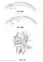 Fig. 19 - Suture passer with radiused upper jaw