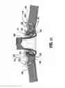 Fig. 08 - Anastomotic staple with capillary which expels a bonding agent upon deformation