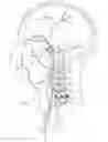 Fig. 02 - Embolic implant and method of use
