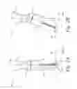 Fig. 03 - Angled craniotome and minimal plating system for improved cosmesis and structural integrity of craniotomies