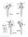 Fig. 08 - POLYAXIAL BONE ANCHORING DEVICE WITH ENLARGED PIVOT ANGLE
